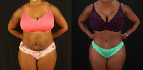 Tummy Tuck case #7282