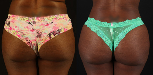Tummy Tuck case #7282