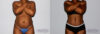 Tummy Tuck case #7096 slider thumbnail