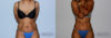 Tummy Tuck case #7093 slider thumbnail