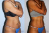 Tummy Tuck case #7093 slider thumbnail