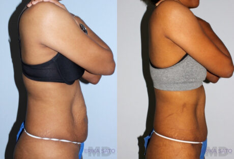 Tummy Tuck case #7093