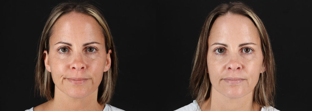 Botox® & Other Neuromodulators case #5064