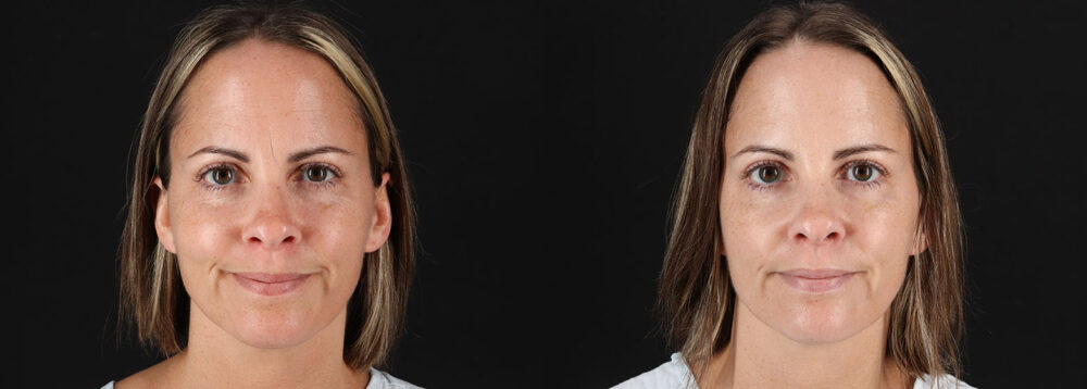 Botox® & Other Neuromodulators case #5064