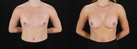 Breast Augmentation case #6478