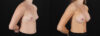 Breast Augmentation case #6478 slider thumbnail