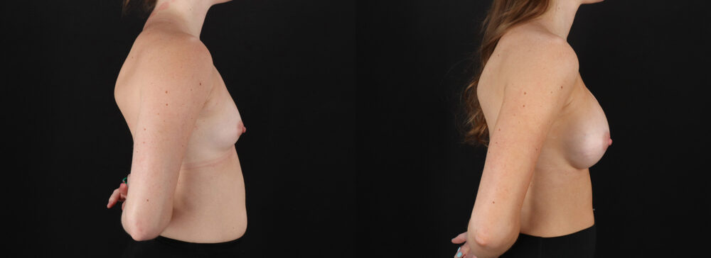 Breast Augmentation case #6478