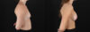Breast Augmentation case #6478 slider thumbnail