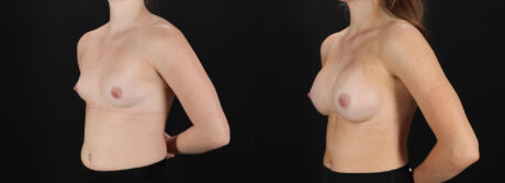 Breast Augmentation case #6478