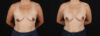 Breast Augmentation case #6497 slider thumbnail