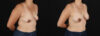Breast Augmentation case #6497 slider thumbnail