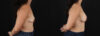 Breast Augmentation case #6497 slider thumbnail