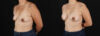 Breast Augmentation case #6497 slider thumbnail