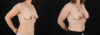 Breast Augmentation case #6472 slider thumbnail