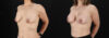 Breast Augmentation case #6472 slider thumbnail