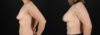 Breast Augmentation case #6472 slider thumbnail