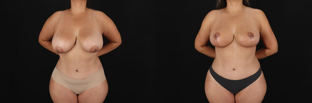 Breast Lift case #7820