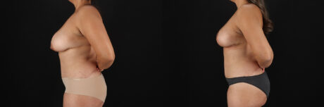Breast Lift case #7820
