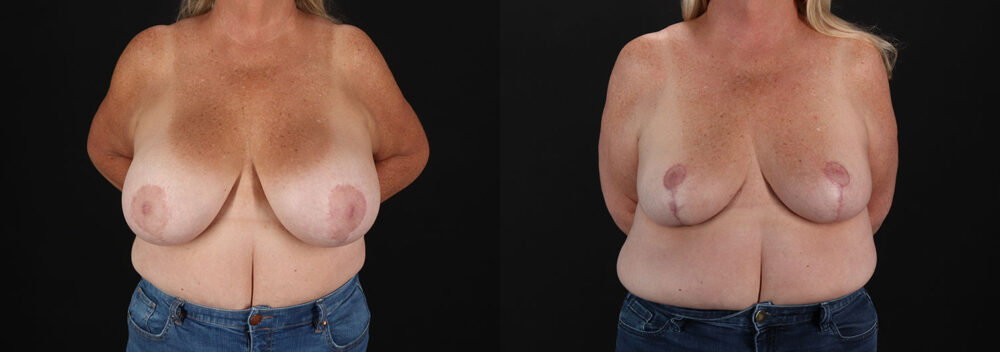 Implant Removal case #258480