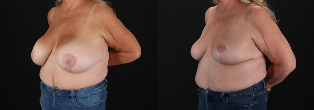 Implant Removal case #258480