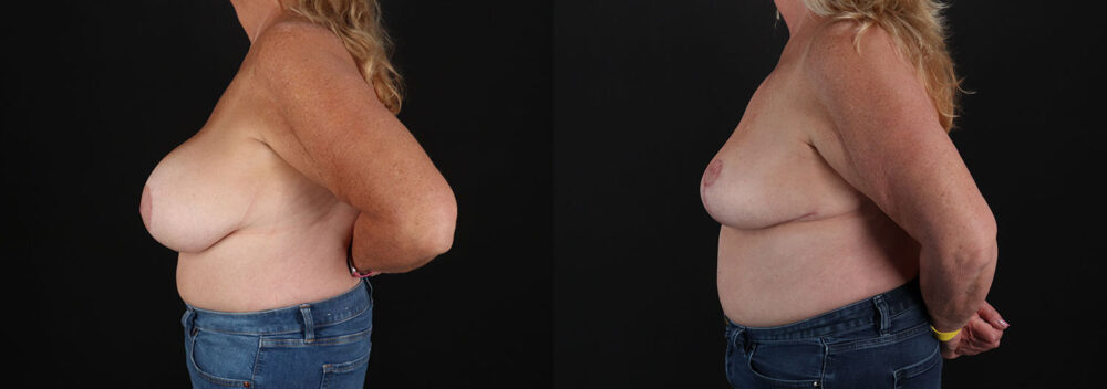 Implant Removal case #258480