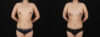 Fat Grafting to the Breast case #256223 slider thumbnail