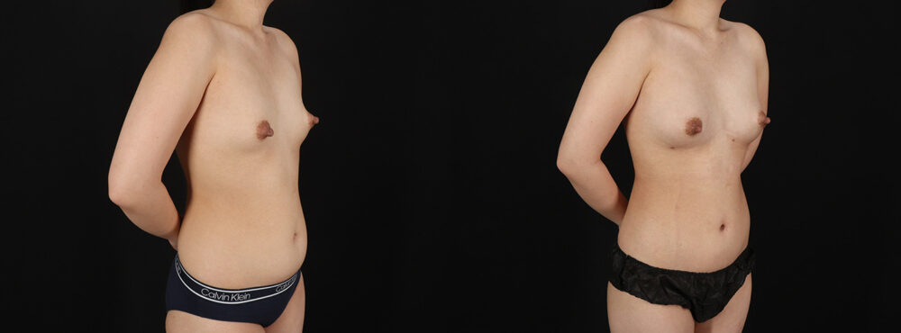 Fat Grafting to the Breast case #256223
