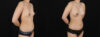 Fat Grafting to the Breast case #256223 slider thumbnail