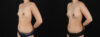 Fat Grafting to the Breast case #256223 slider thumbnail