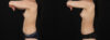 Fat Grafting to the Breast case #256223 slider thumbnail