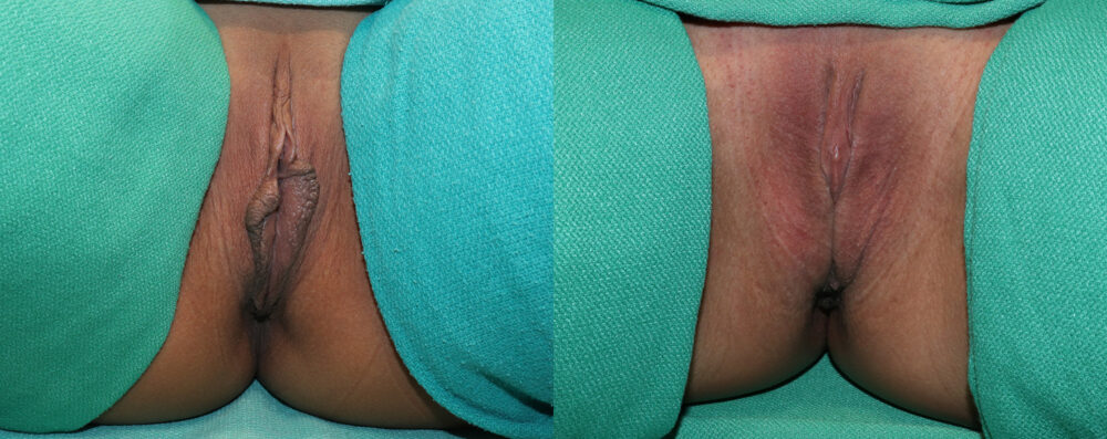 Labiaplasty case #5797
