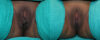 Labiaplasty case #5800 slider thumbnail