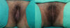 Labiaplasty case #5814 slider thumbnail