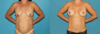 Breast Lift with Implants case #7872 slider thumbnail