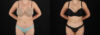 Liposuction case #6236 slider thumbnail