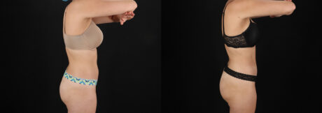 Liposuction case #6236