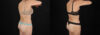 Liposuction case #6236 slider thumbnail