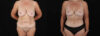 Post Bariatric Surgery (Massive Weight Loss) case #6784 slider thumbnail