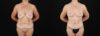 Post Bariatric Surgery (Massive Weight Loss) case #6784 slider thumbnail