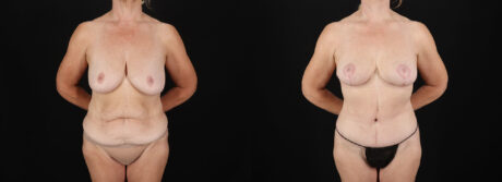 Post Bariatric Surgery (Massive Weight Loss) case #6784
