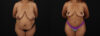 Post Bariatric Surgery (Massive Weight Loss) case #6783 slider thumbnail