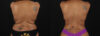 Post Bariatric Surgery (Massive Weight Loss) case #6783 slider thumbnail