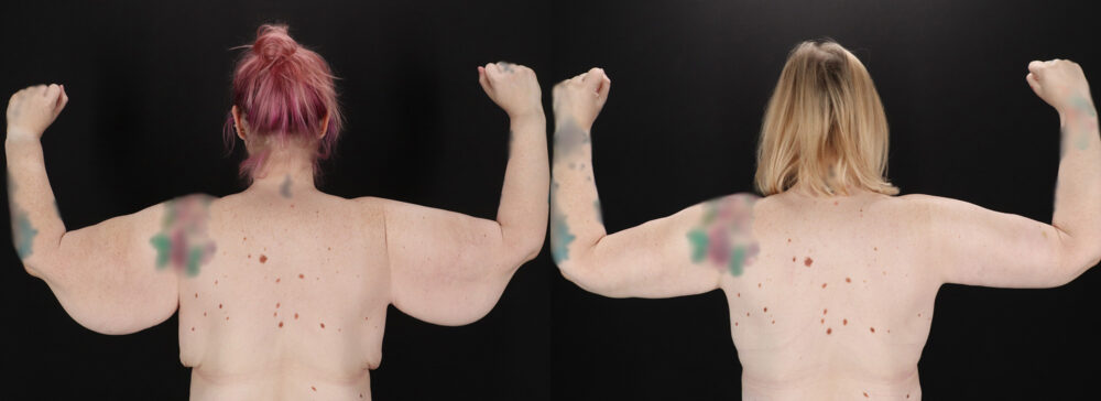 Post Bariatric Surgery (Massive Weight Loss) case #6786