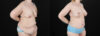 Post Bariatric Surgery (Massive Weight Loss) case #6786 slider thumbnail