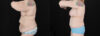 Post Bariatric Surgery (Massive Weight Loss) case #6786 slider thumbnail