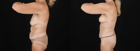 Post Bariatric Surgery (Massive Weight Loss) case #6784