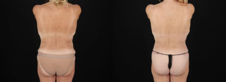 Post Bariatric Surgery (Massive Weight Loss) case #6784