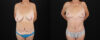 Mommy Makeover case #6691 slider thumbnail