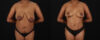 Mommy Makeover case #6689 slider thumbnail
