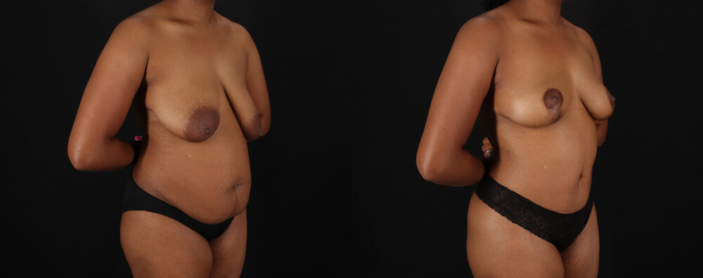 Mommy Makeover case #6689